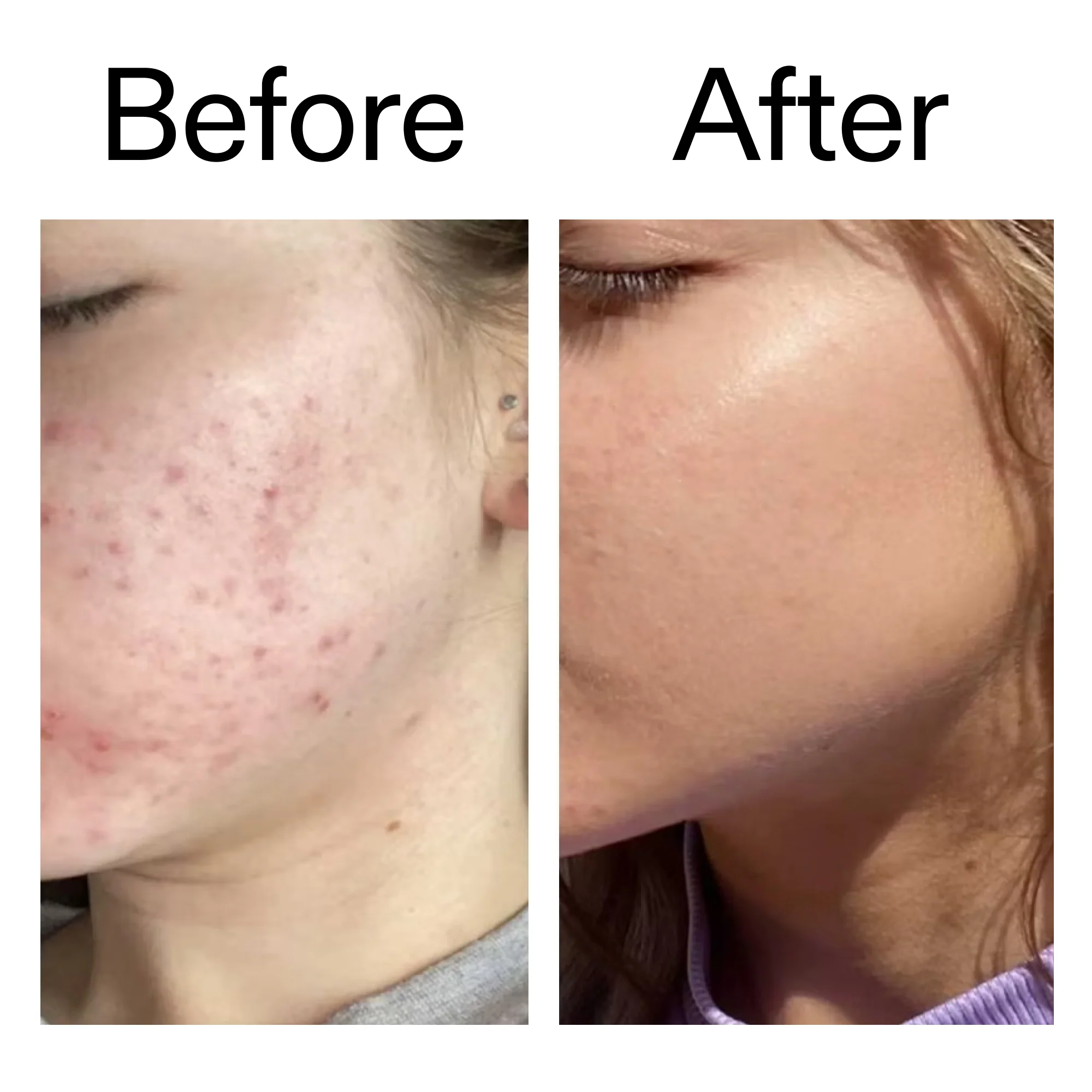 Beta Hydroxy Acid (BHA) Serum - Image 8