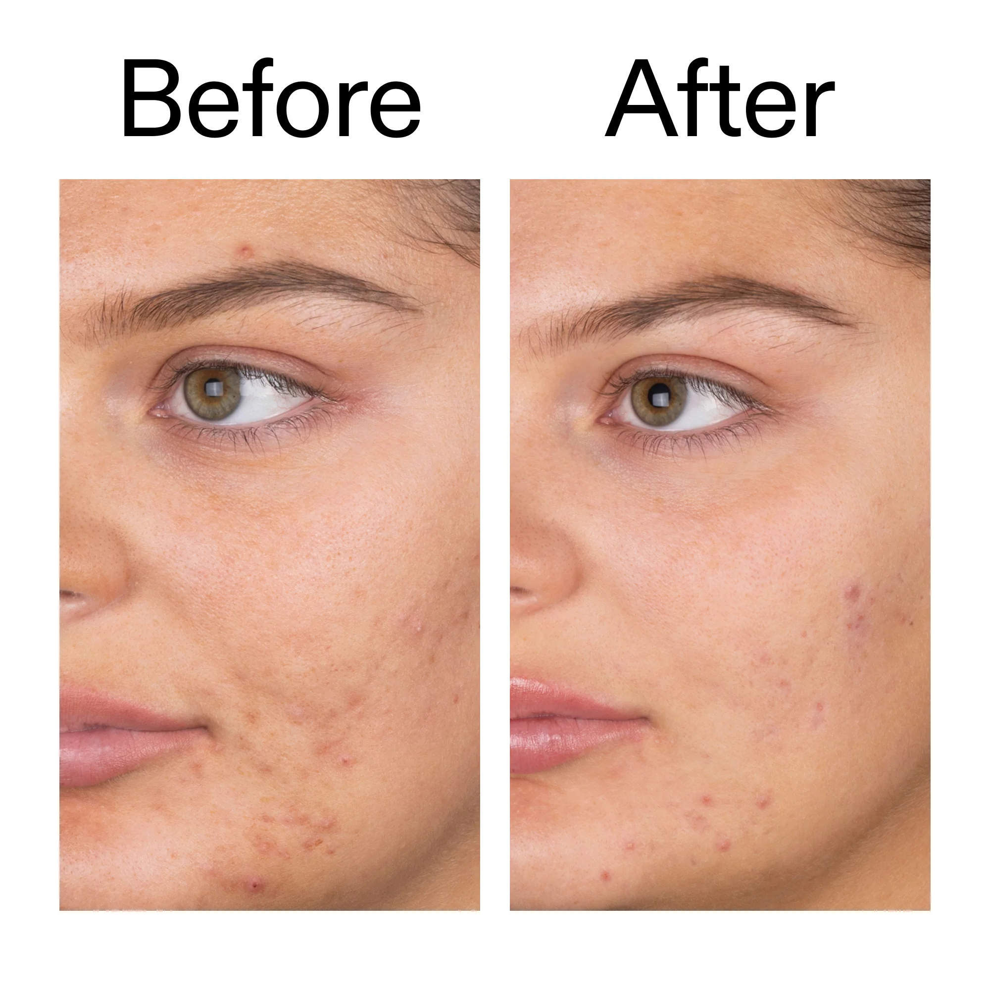 Salicylic Acid Cleanser - 150ml - Image 10