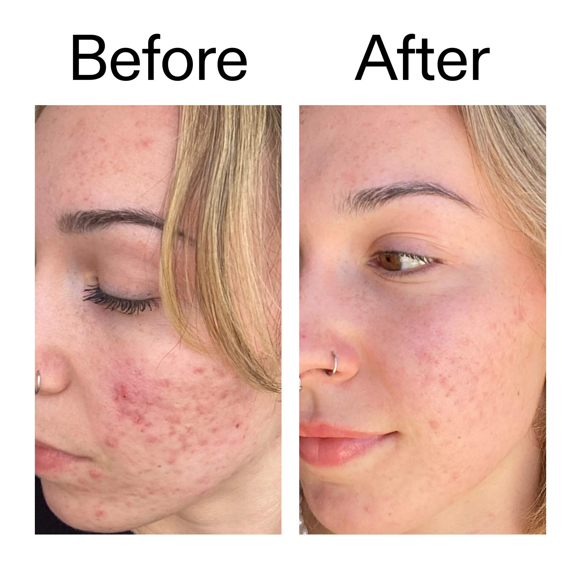 10% Azelaic Acid Serum for Redness Relief - Image 11