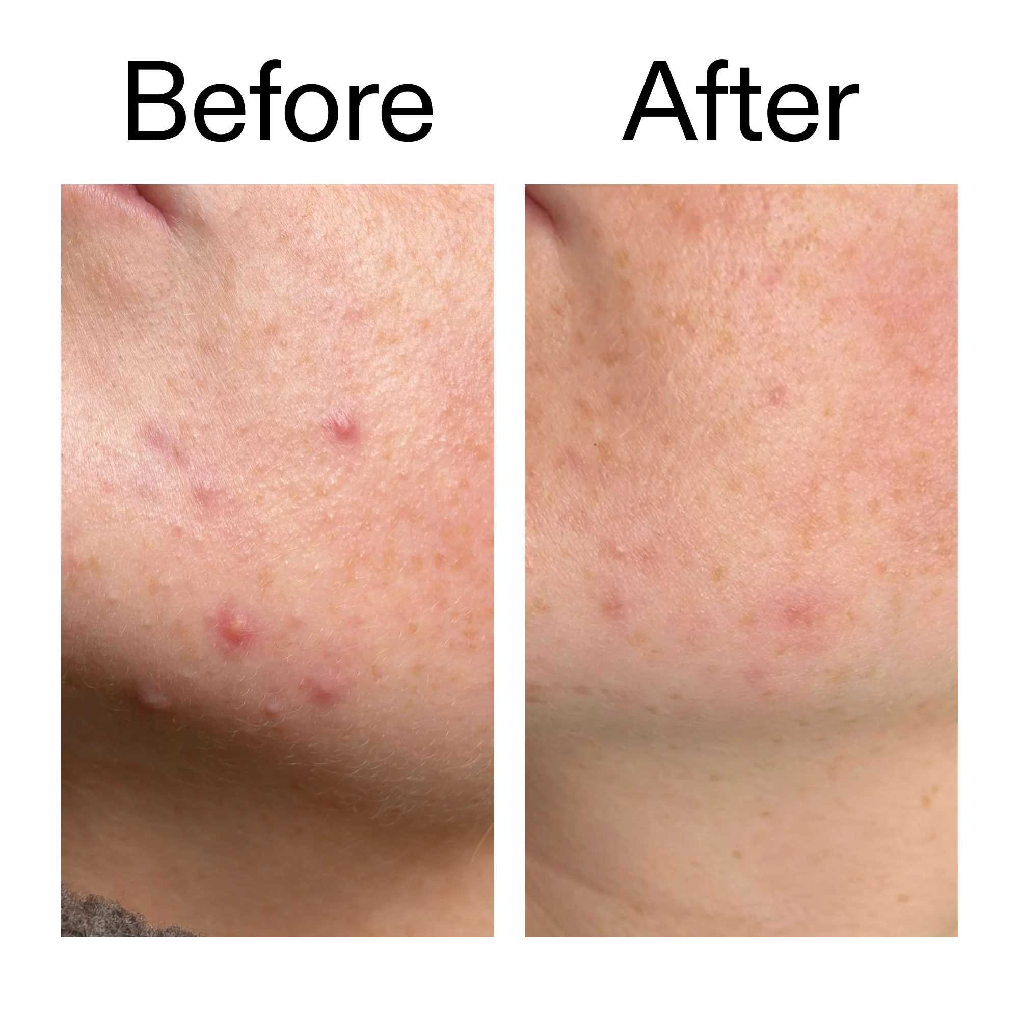 10% Azelaic Acid Serum for Redness Relief - Image 12
